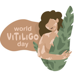 Woman With Skin Vitiligo World Vitiligo Day