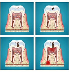 Stages Progress Dental Caries And Toothache