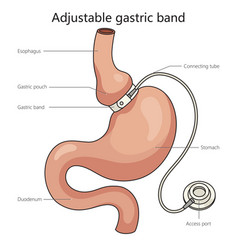 Adjustable Gastric Band Diagram Medical Science