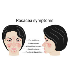 Symptoms Rosacea