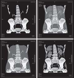 Set X-ray Of Human Abdomen With Pelvic Bone