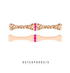 Medical Problem Osteoporosis Disease