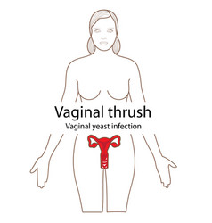 Vaginal Thrush In The Female Body Poster Vector Vaginal Thrush In The Female Body Poster Vector