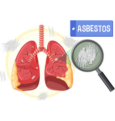 Diagram Showing Asbestosis In Lungs