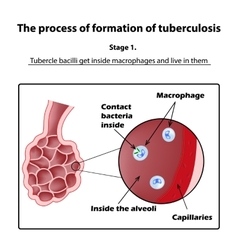 Development Of Tuberculosis Stage 1