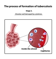 Development Of Tuberculosis Stage 2