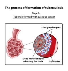 Development Of Tuberculosis Stage 3