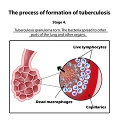 Development Of Tuberculosis Stage 4