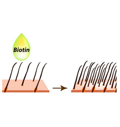 Treatment Of Alopecia Vitamins Hair Biotin