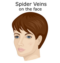 Facial Spider Veins