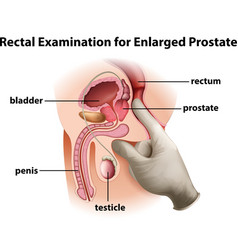 Rectal Examination For Enlarged Prostate