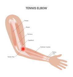 Lateral Epicondylitis Tennis Elbow