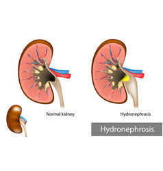 Hydronephrosis Urinary Tract Dilation