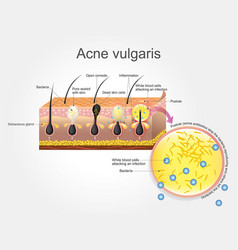 Acne Vulgaris