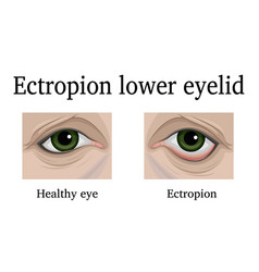 Ectropion Of The Lower Eyelid