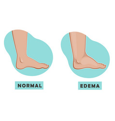 A Swollen Foot And Ankle And Normal Foot