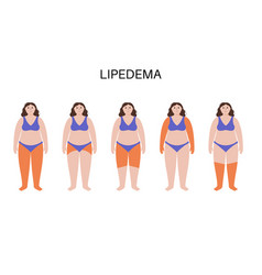 Lipedema Fat Zones