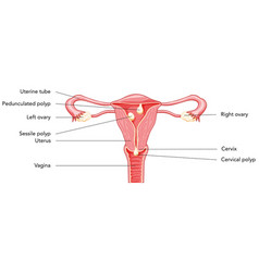 Polyp In The Uterus With Inscriptions Diagram