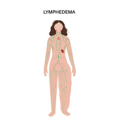 Lymphedema Leg Swelling