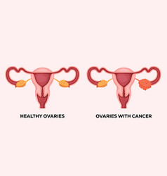 Healthy Ovaries And Ovaries With Cancer