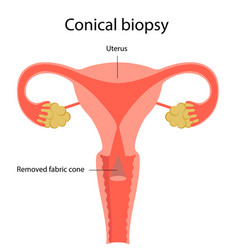 A Conical Biopsy