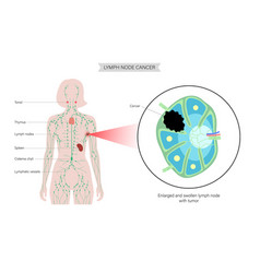 Lymphoma Cancer Concept