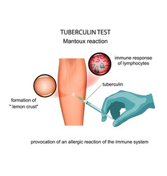 Tuberculin Test Mantoux