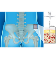 Bone Marrow Aspiration And Biopsy