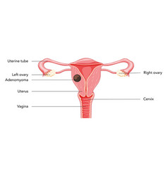 Adenomyoma Adenomyosis With Inscriptions Human