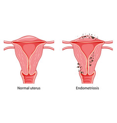 Endometriosis Stages Female Reproductive System