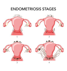 Set Of Endometriosis Stages Female Reproductive