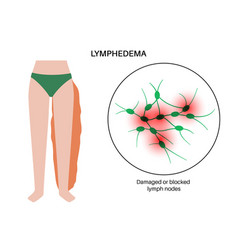 Lymphedema Leg Swelling