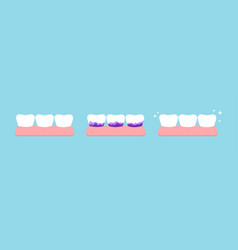 White Tooth And With Yellow Tartar Plaque Before