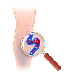 Cross Section Of Varicose Vein Through