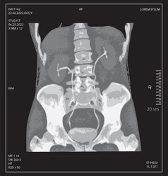 X-ray Of Human Abdomen With Pelvic Bone And Spine