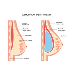 Breast Implant Concept