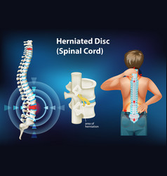 Diagram Showing Herniated Disc