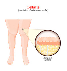 Cellulite Females Legs Human Skin With Orange