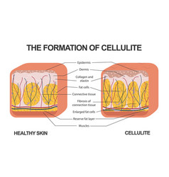 Formation Cellulite Cellulite Occurs