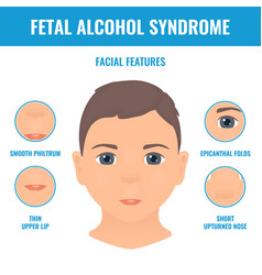 Fetal Alcohol Syndrome Facial Features In A Child