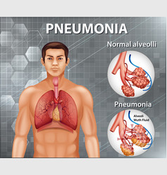 Comparison Healthy Alveoli And Pneumonia