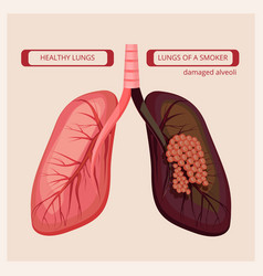 Smoker Lungs Smoke Human Damage Lung Cancer