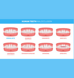 Malocclusion Of Teeth Infographics