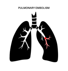 Pulmonary Embolism Disease