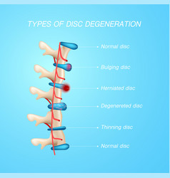 Spinal Disc Diseases