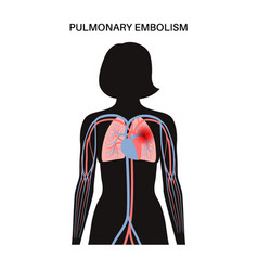 Pulmonary Embolism Disease