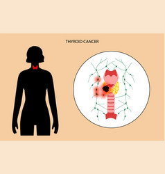 Thyroid Cancer Stages