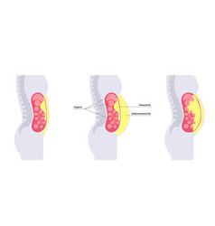 Visceral Fat Diagram