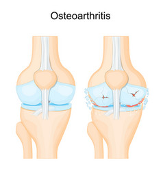 Knee Osteoarthritis Degenerative Joint Disease