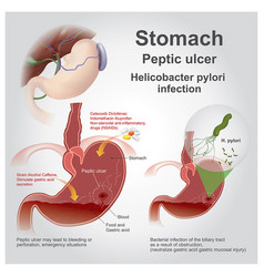 Stomach Peptic Ulcer Charts